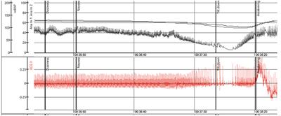 Reflex Atrioventricular Block